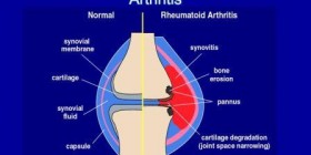 Artrite Reumatoide e Alimentazione